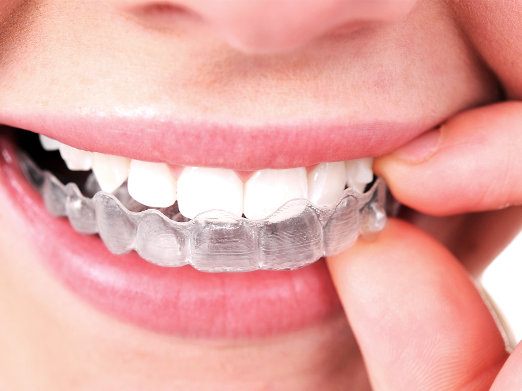 Featured image for “What is the difference between Invisalign and Metal Braces?”