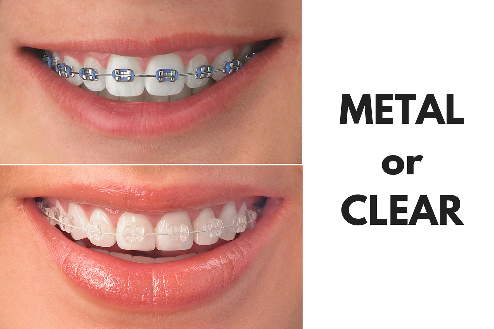 Ask Your El Paso Dentist: Should I Get Metal or Clear Braces?