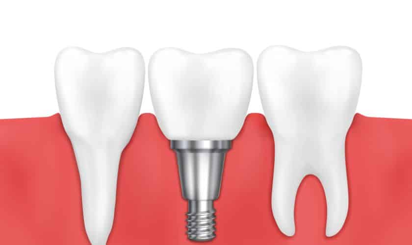Featured image for “4 Easy Steps To Maintain Your Dental Implants”