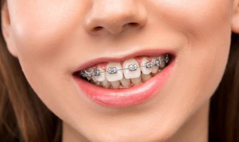 How Do Braces Align Your Teeth?