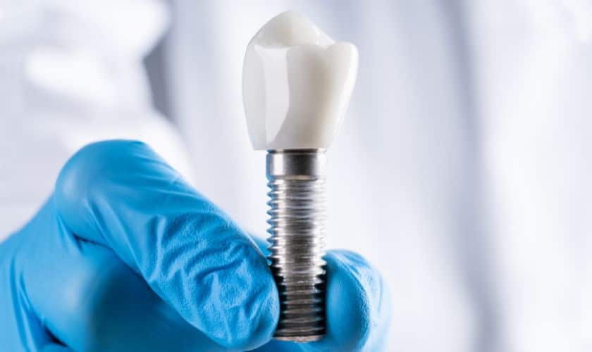 6 Dental Implant Stages to Receive the Smile