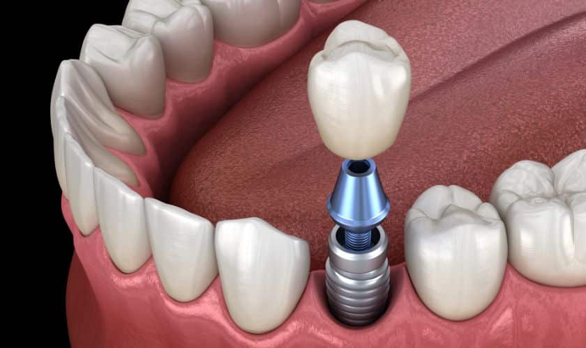 Dental Implants El Paso