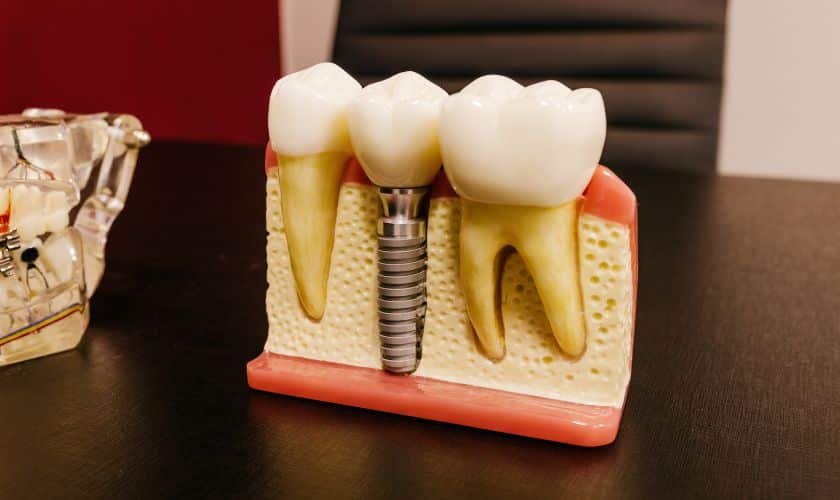 Featured image for “Why Dental Implants Are Preferred Tooth Replacement?”