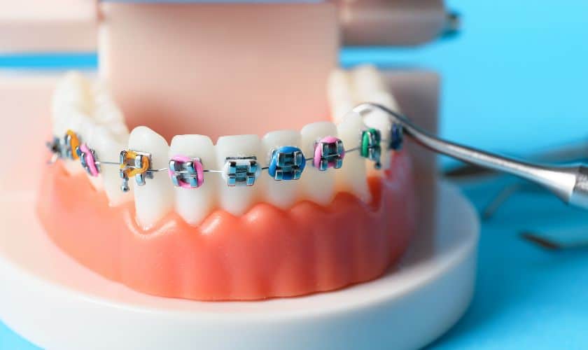 Featured image for “The Role of Diet in Orthodontic Treatment Success”
