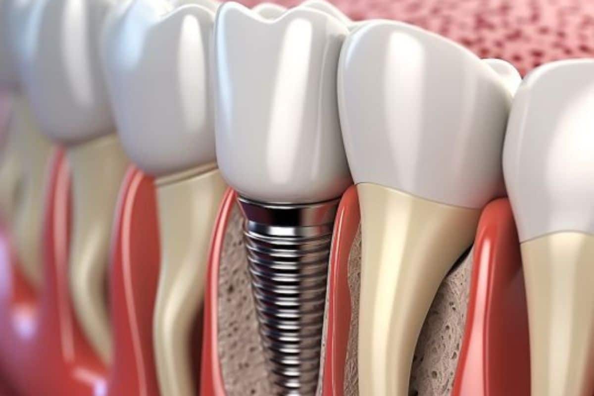 Dental Implants El Paso