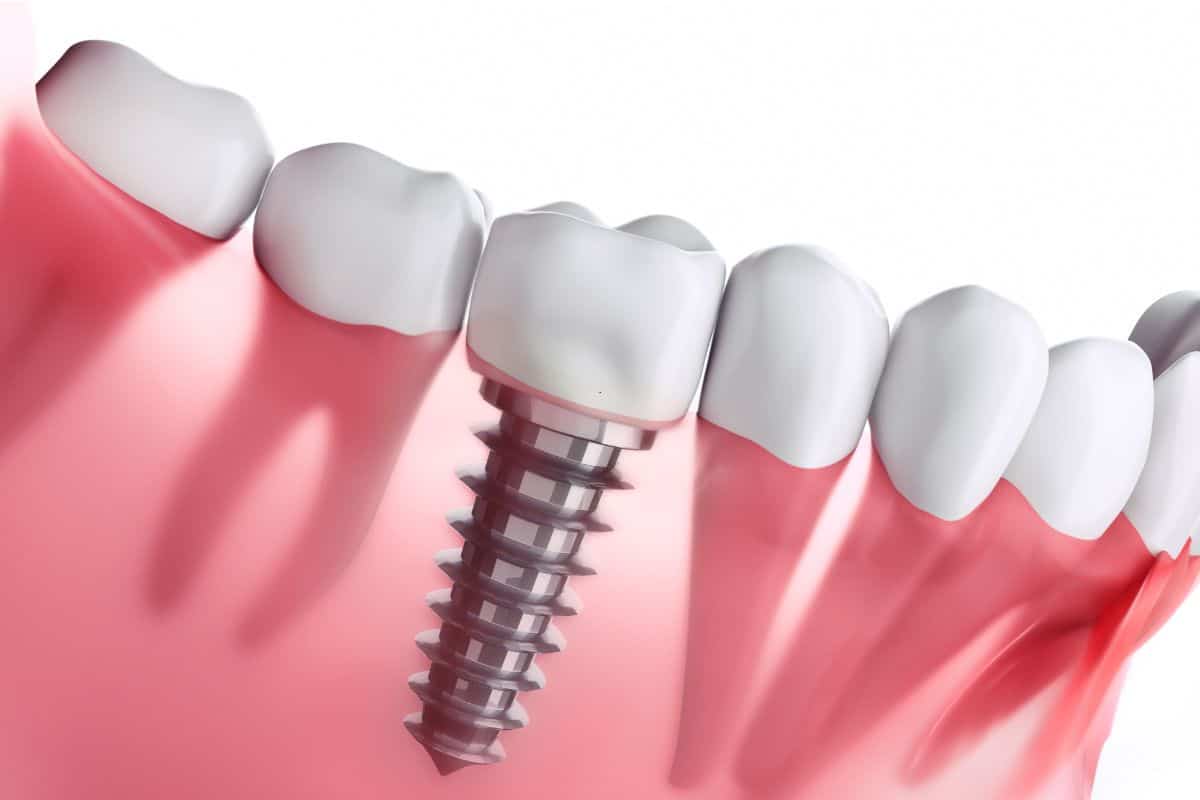 dental implants in el paso