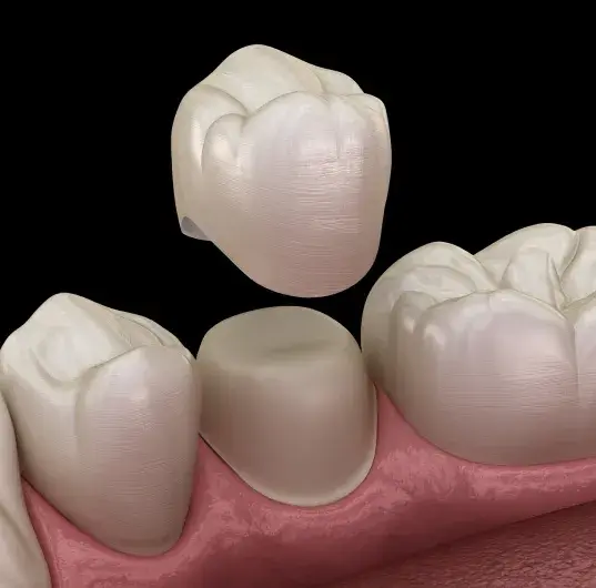 Dental Crowns in El Paso, TX