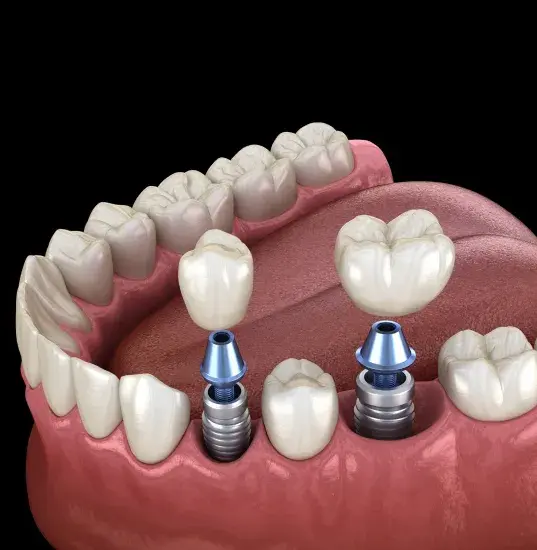 Dental Implants in El Paso, TX